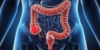 Preta Gil é mais uma vítima do câncer colorretal: e você, está seguro?